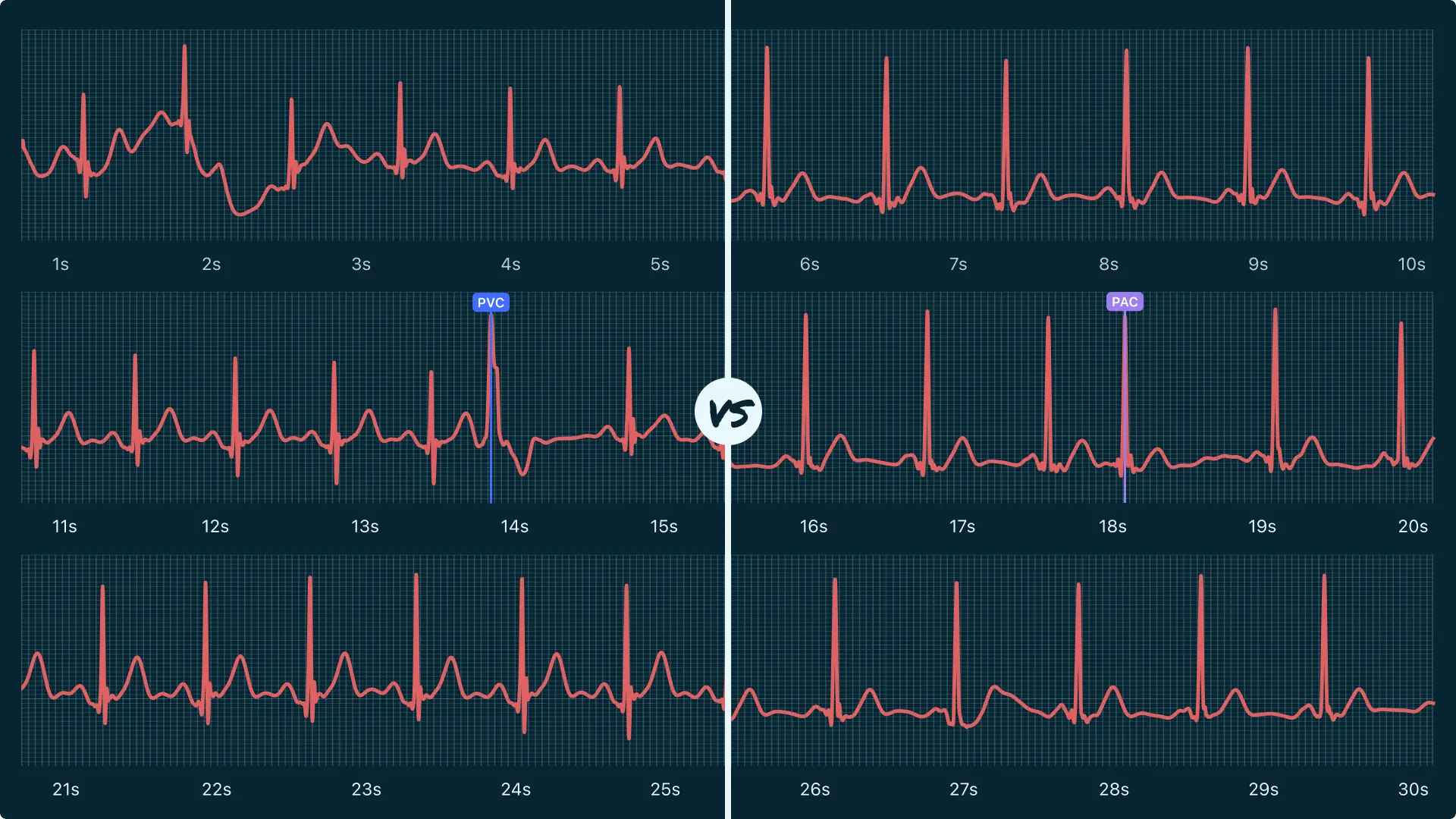 Premature Ventricular Contractions Vs Premature Atrial Contractions
