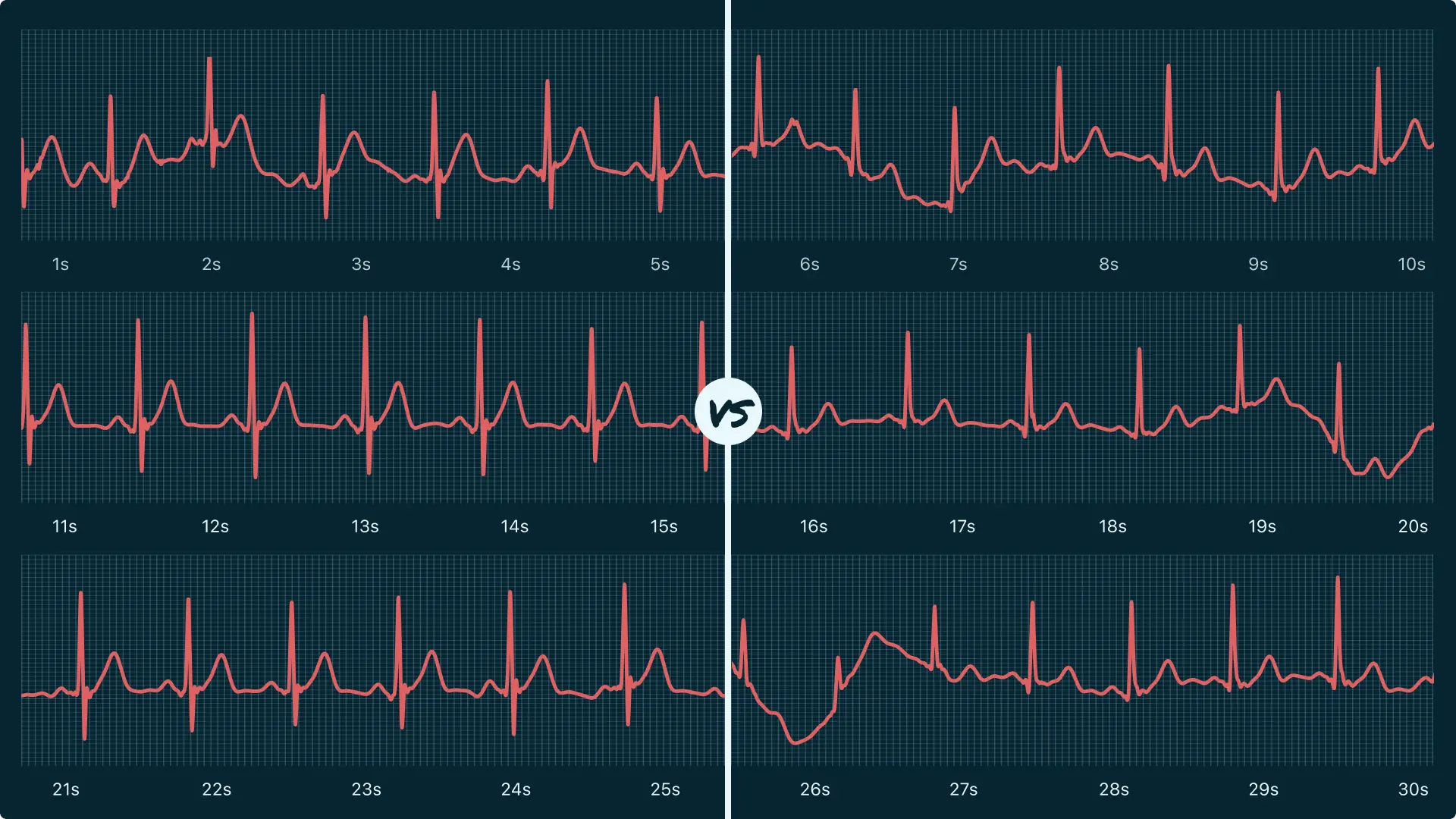 Sinus Rhythm Vs. Sinus Arrhythmia on Your Watch ECG | Qaly