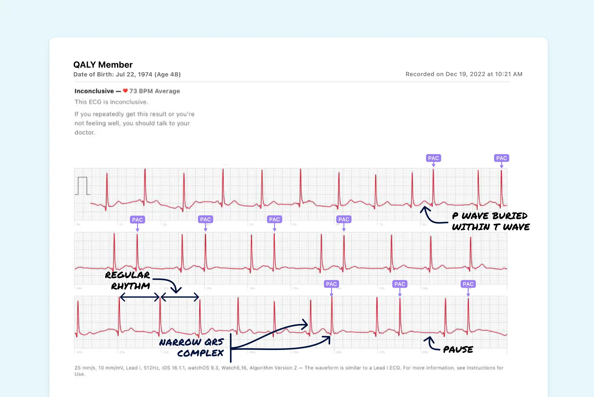 Is Your Heart Skipping Beats Bigeminy Or Trigeminy Find Out Now - gst3f2i