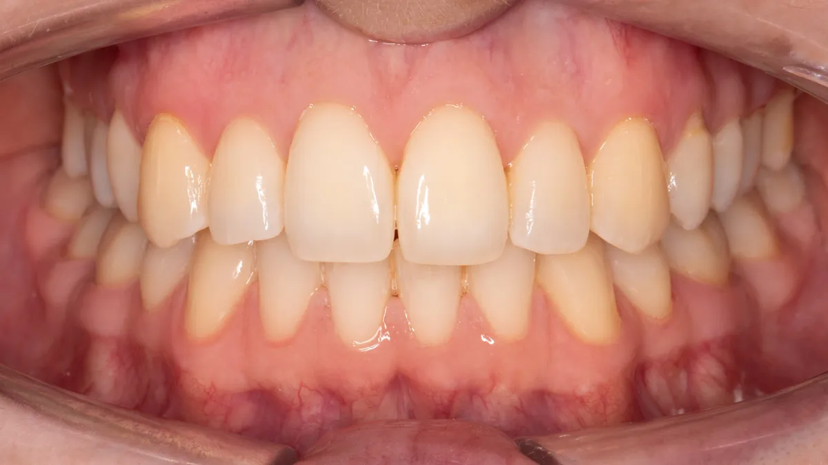 Pred & po Blanc dental studio