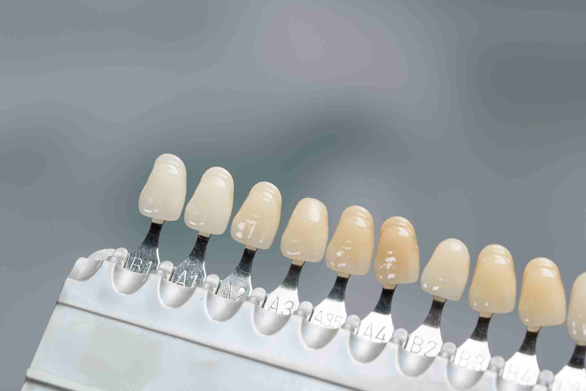 How Long Does the Veneer Procedure Take?
