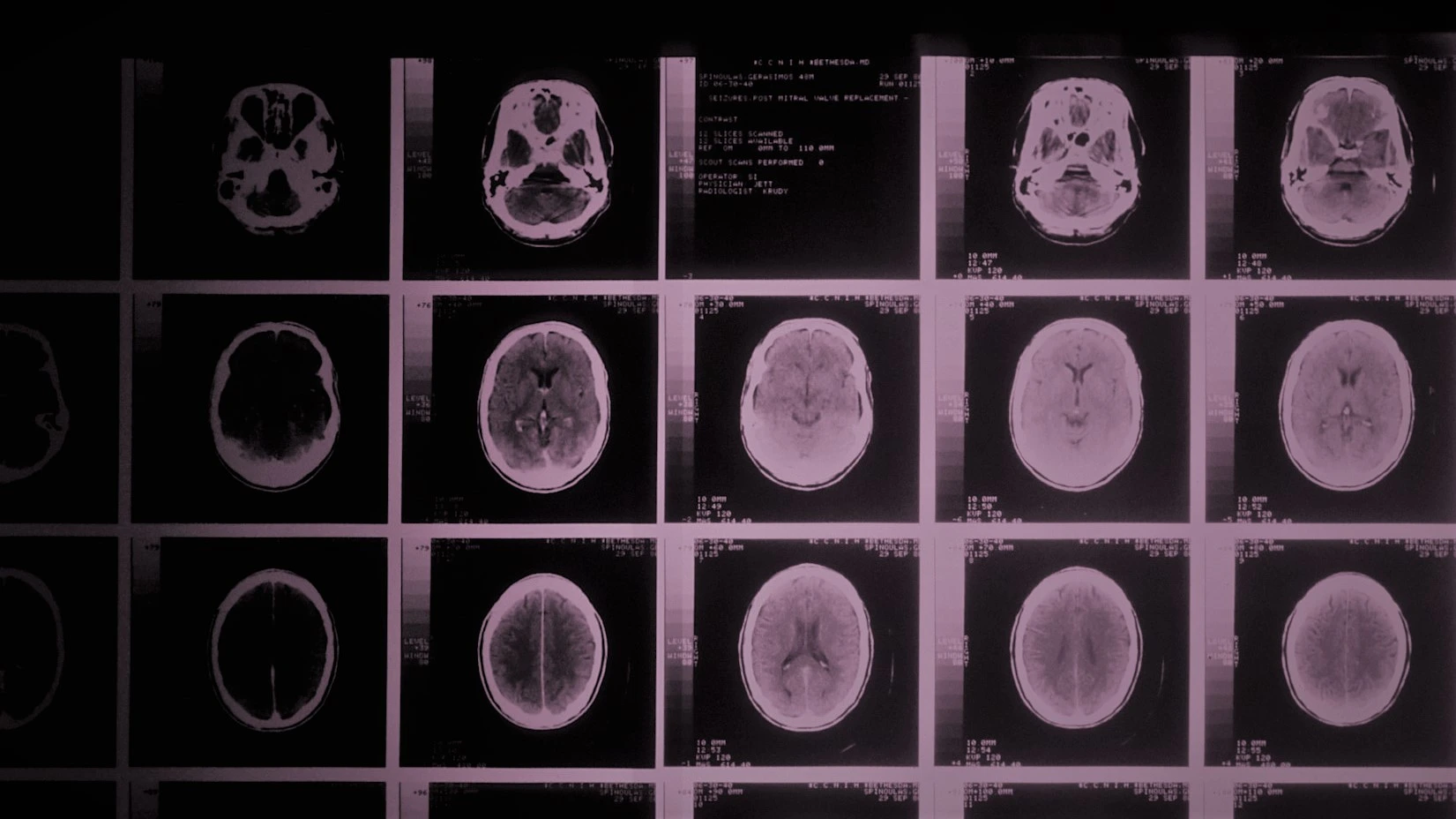 A CAT scan showing many cross-sections of a brain