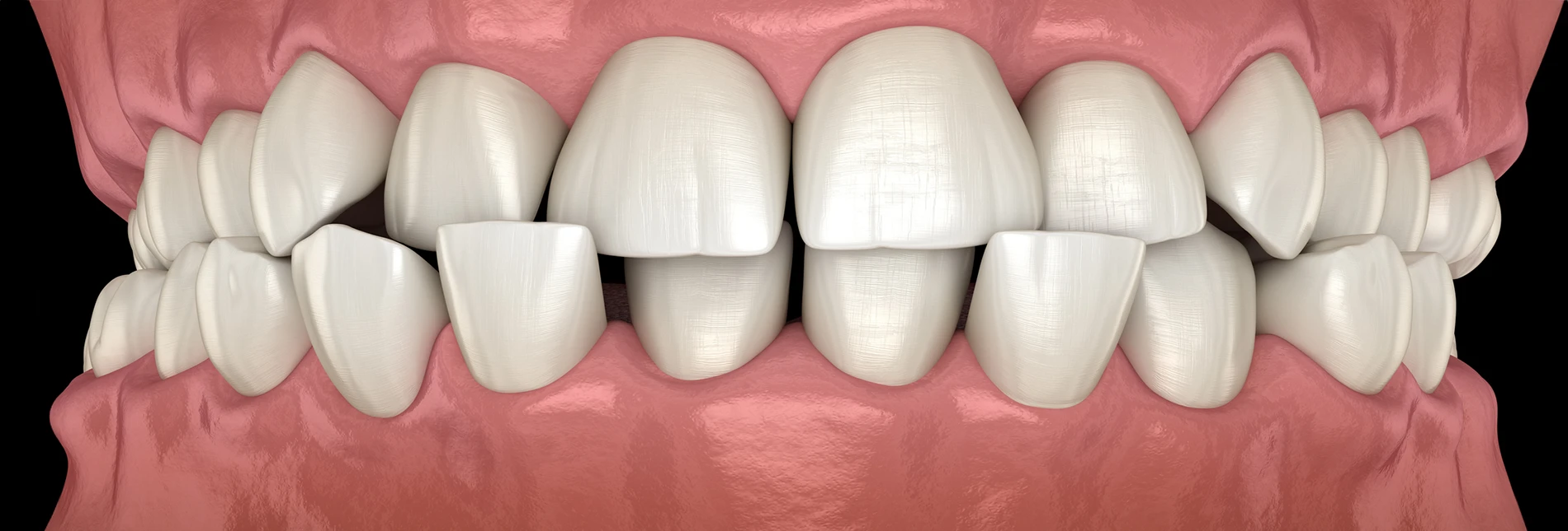 How Do You Fix Malocclusion Without Surgery?