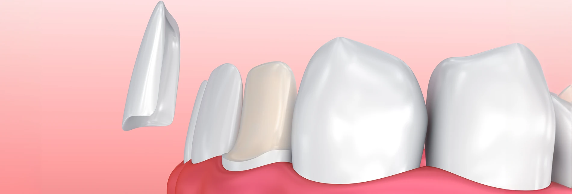 How To Clean Veneers? Steps You Should Follow