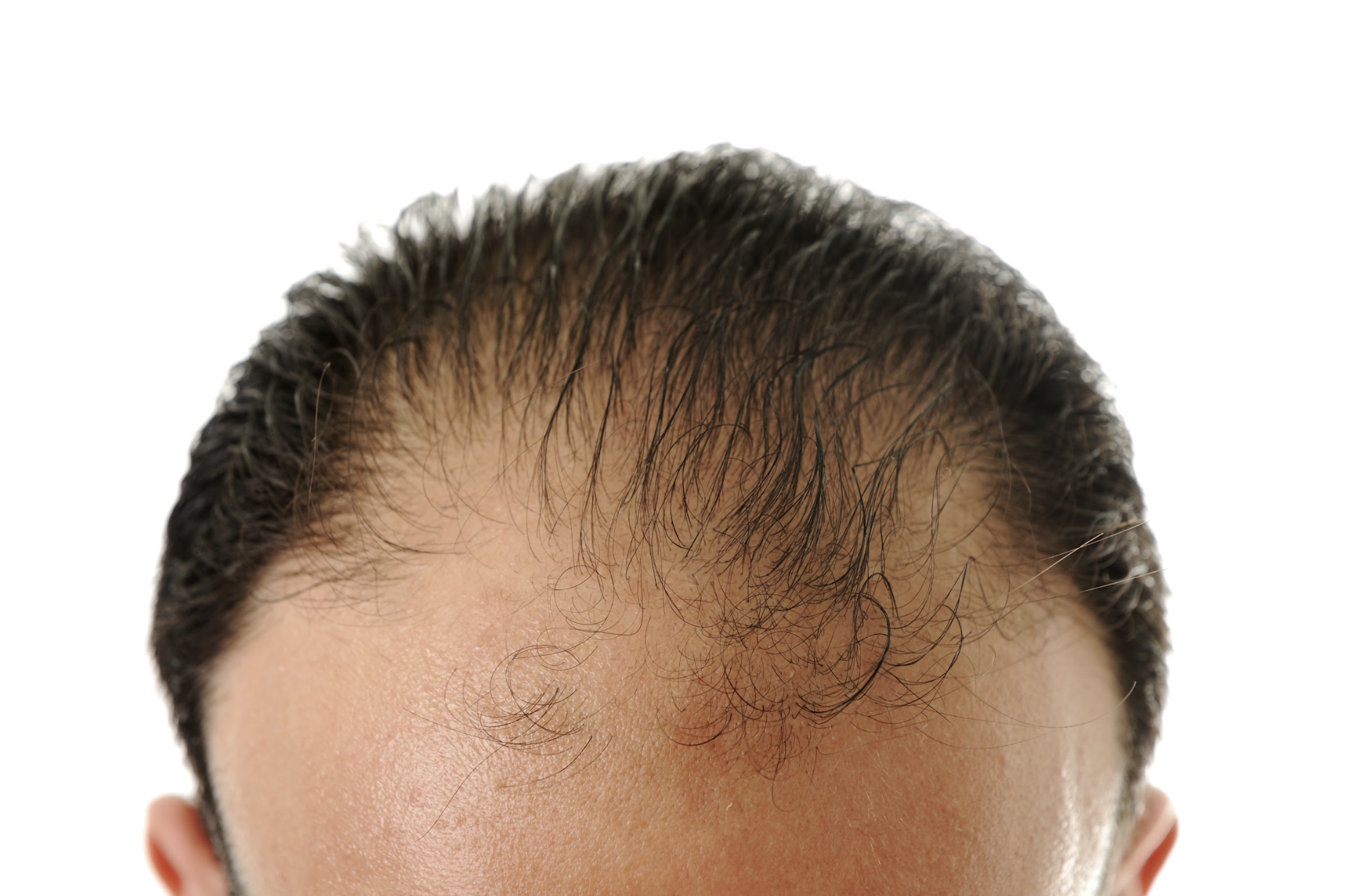 Hair Loss (Alopecia)