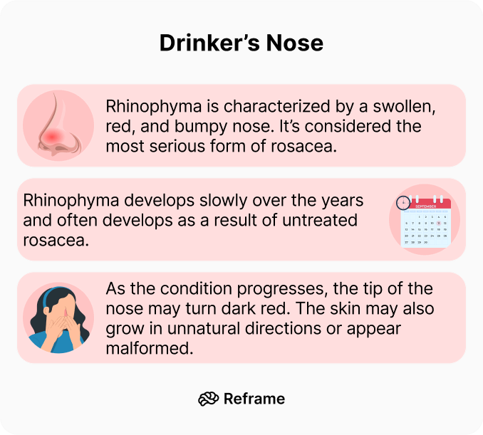 Alcoholic Nose What It Is and How To Cope