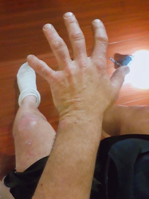 Peter's Skin after using K Goo Soap