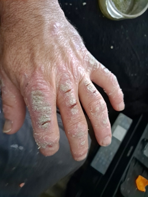 Peter's Psoriasis before using K Goo Soap