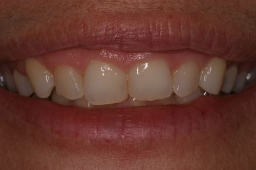 before and after treatment