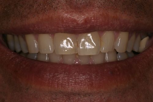 before and after treatment