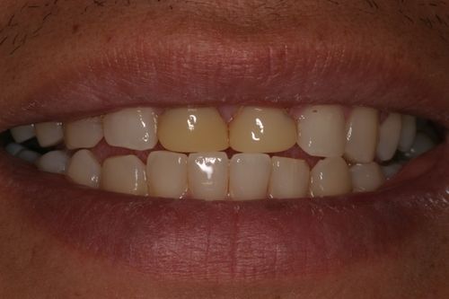 before and after treatment