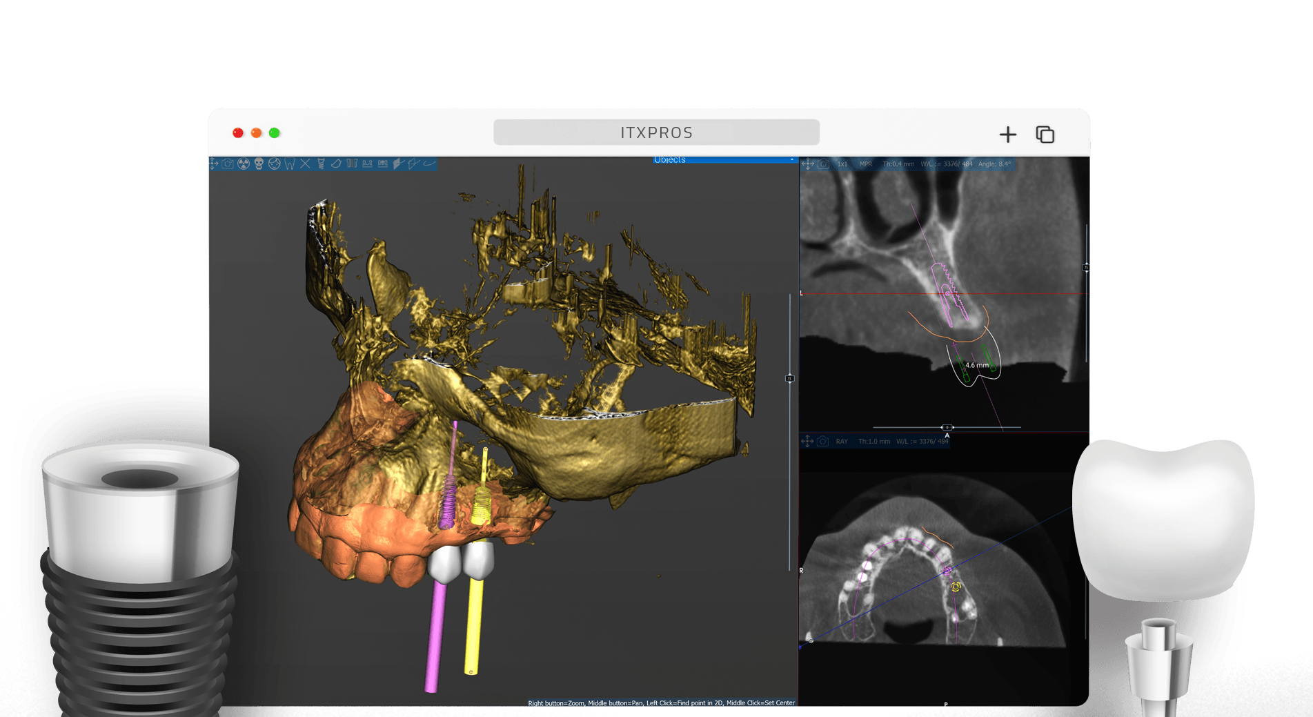 Tx. Plan Simulation TX Plan - Implant Planning by ITX Pros