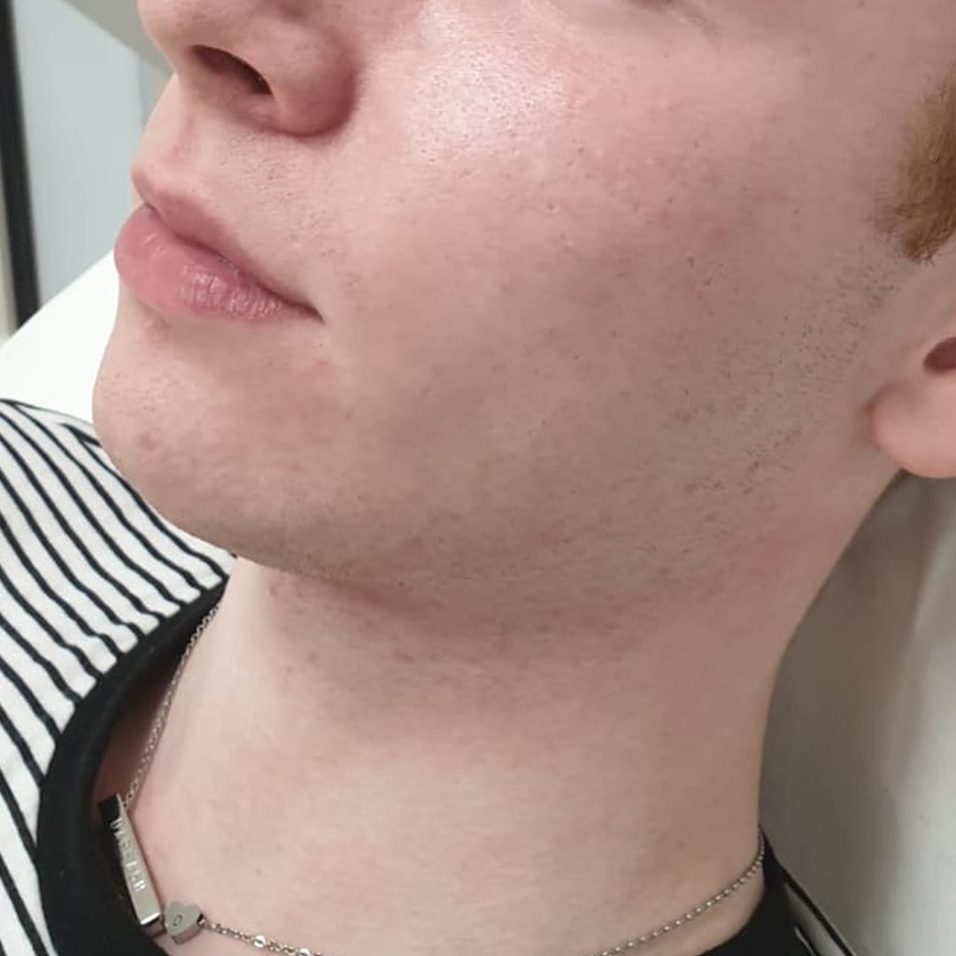 Jaw Sculpting Jawline Shaping Aesthetic Treatments Sisu Clinic Ireland