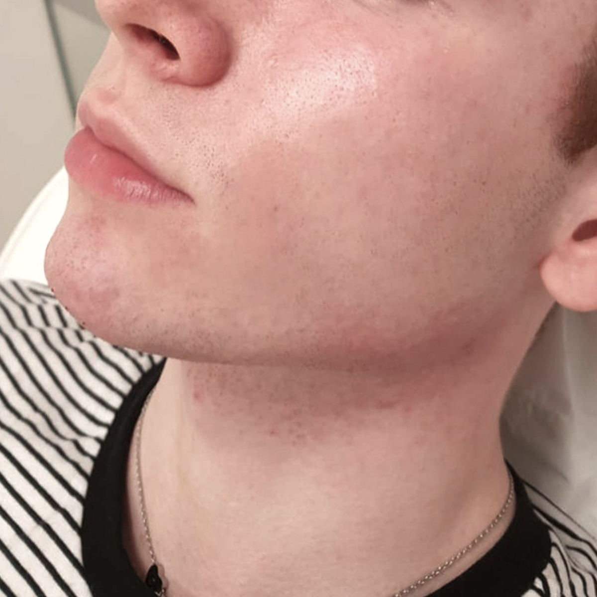 Jaw Sculpting Jawline Shaping Aesthetic Treatments Sisu Clinic