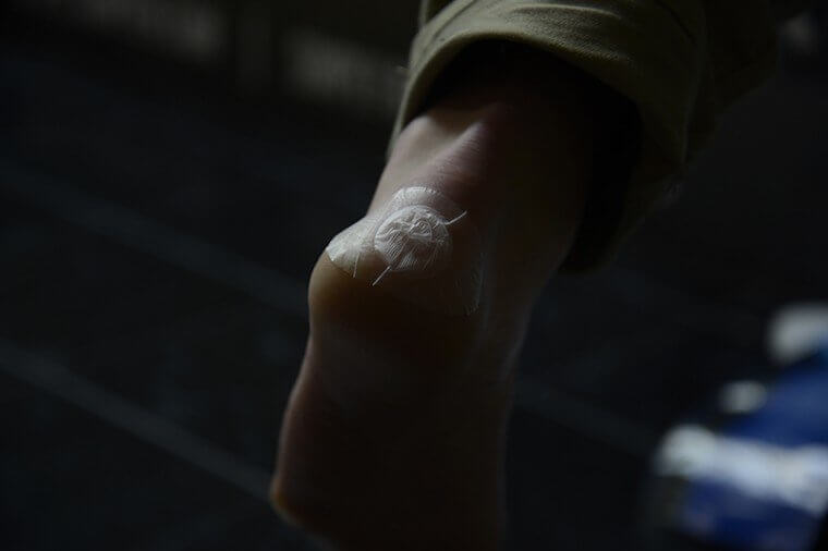 Blistoban on heel
