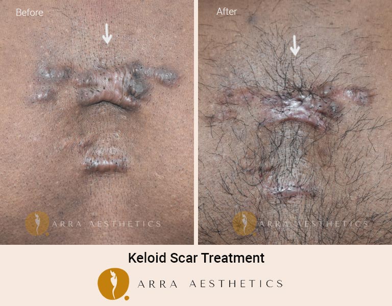 Treat Keloid & Hypertrophic Scar with Laser Treatment Pune