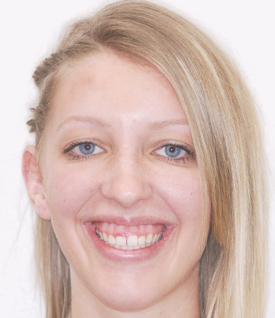 Before & Afters Idaho Orthodontics