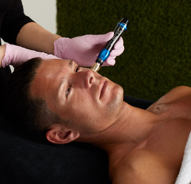 Microneedling