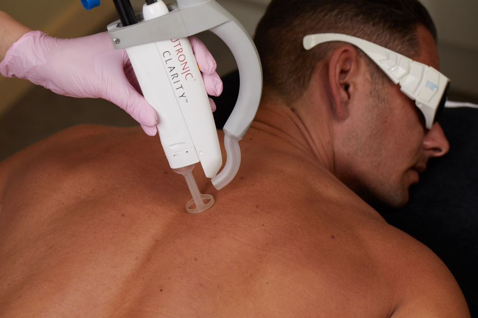 Mens Laser Hair Removal Full Back