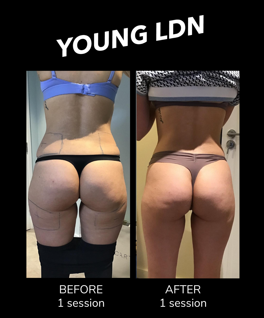 CoolSculpting, clatuu fat freezing before and after