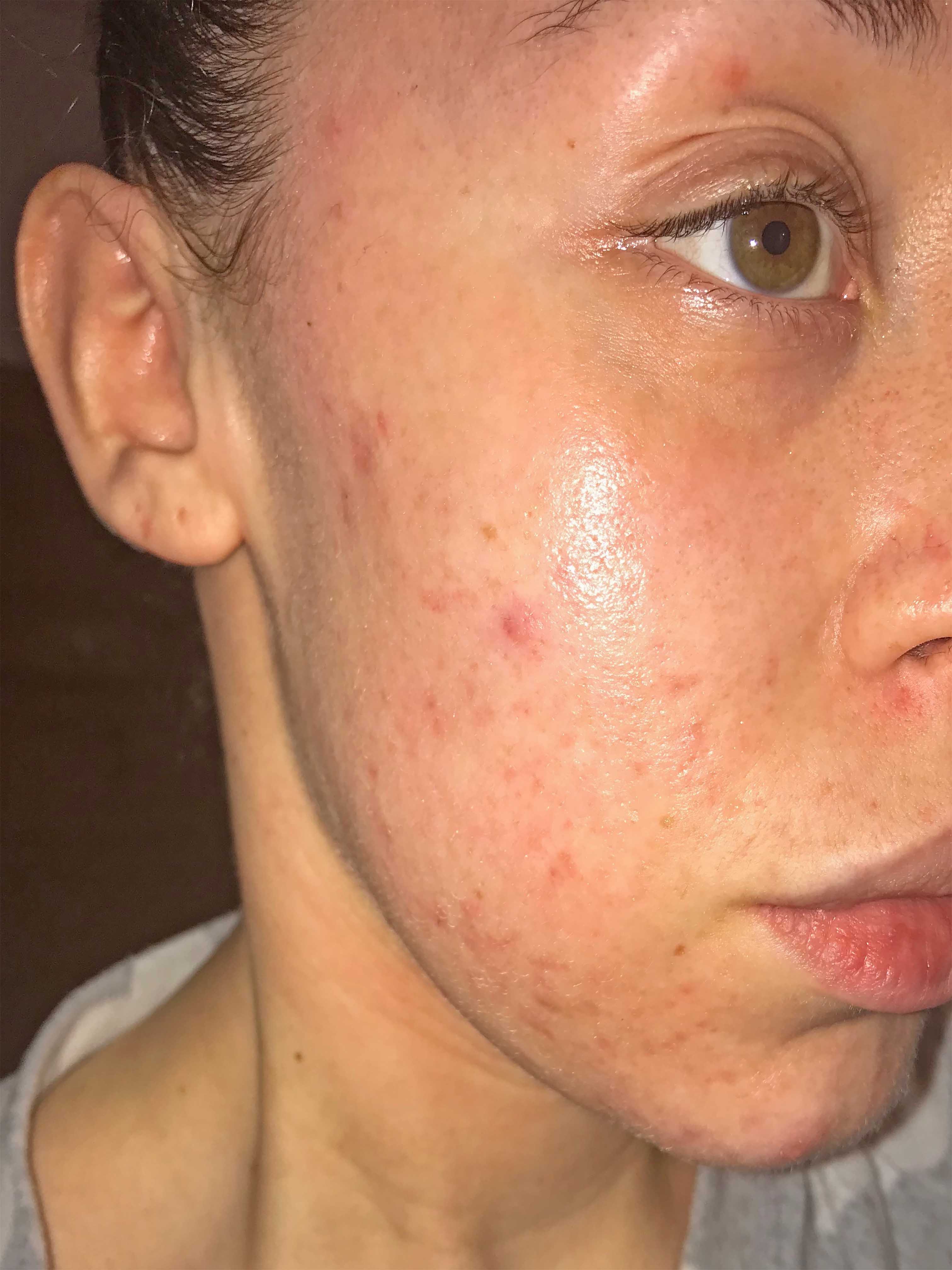 Skin after 3 acne treatments at Young LDN