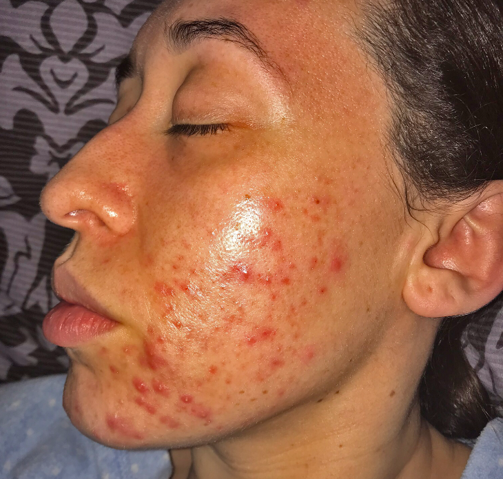 My skin before my acne treatments at Young LDN