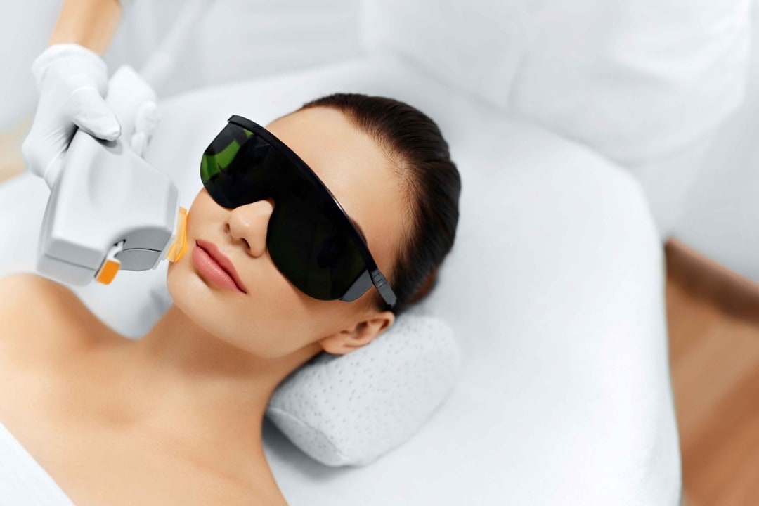 IPL Treatment Young LDN