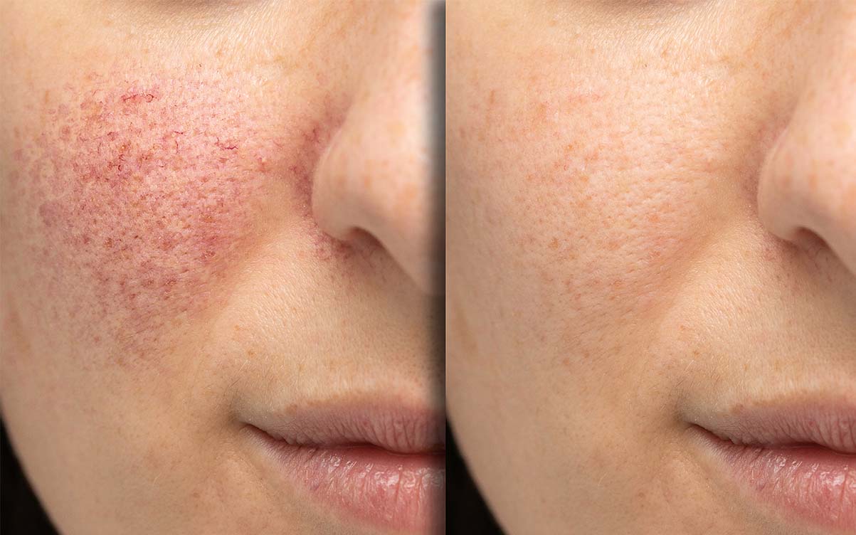 Rosacea treatment London