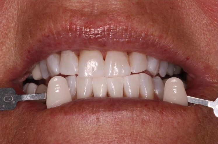 before and after treatment