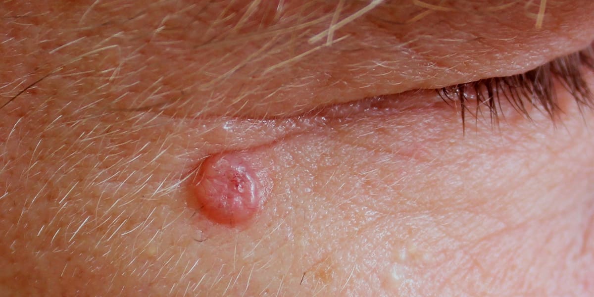 Carcinoma Basocelular: tudo o que você precisa saber sobre o tumor