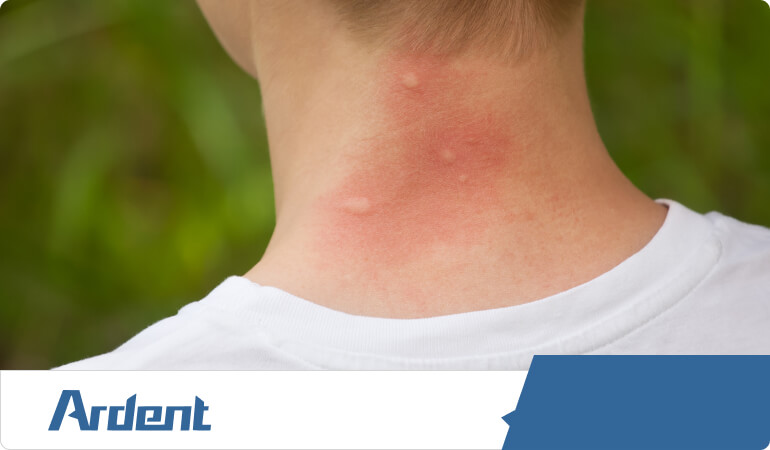 allergic-to-bites