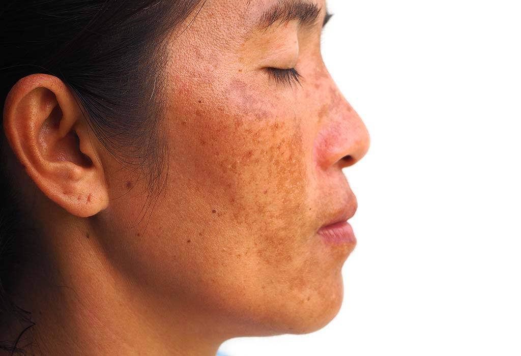 How To Get Rid Of Melasma 5 Best Melasma Treatments