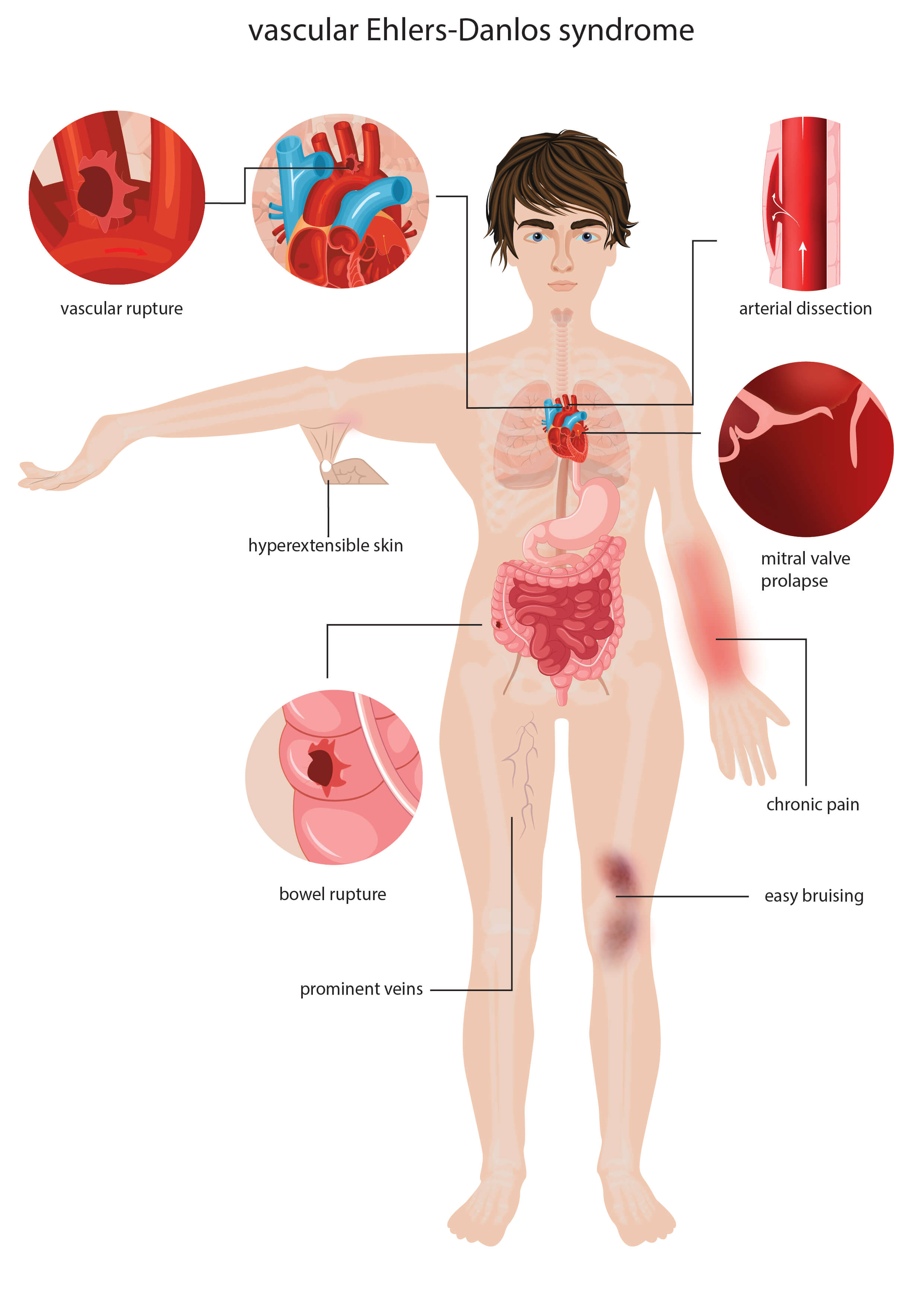 Ehlers-Danlos | Progenics