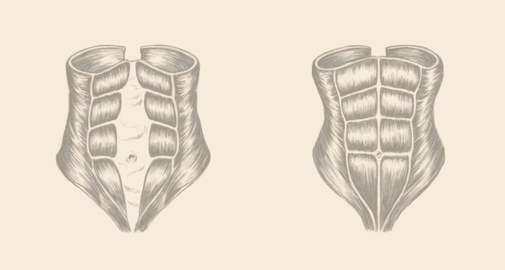 Diastasis Recti Complications Drawing: Every Mother