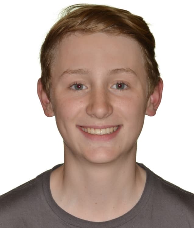 Orthodontic Transformation in Dripping Springs, TX Cunningham