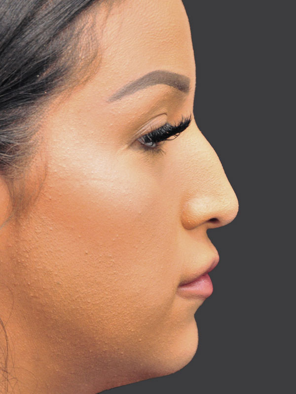 Can Dorsal Hump Go Away Naturally