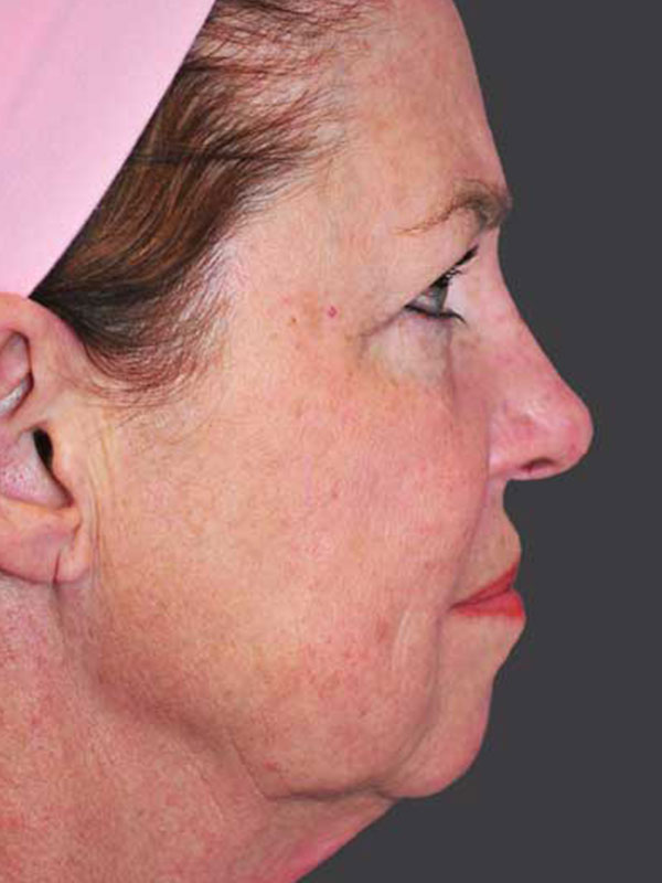 Chin Implant Before And After This Doctors Before Afters Are Insane - qqpx39j