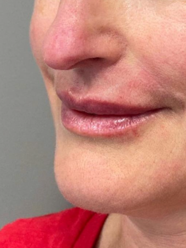 Treatments for Aging Lips