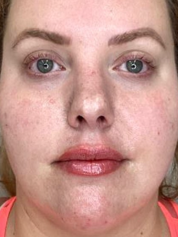 Treatments for Aging Lips