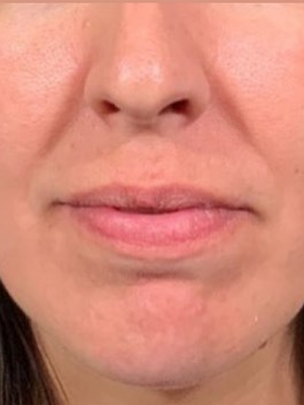 Treatments for Aging Lips