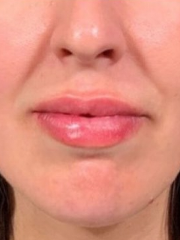 Treatments for Aging Lips