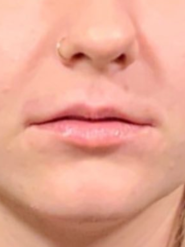 Treatments for Dehydrated Lips