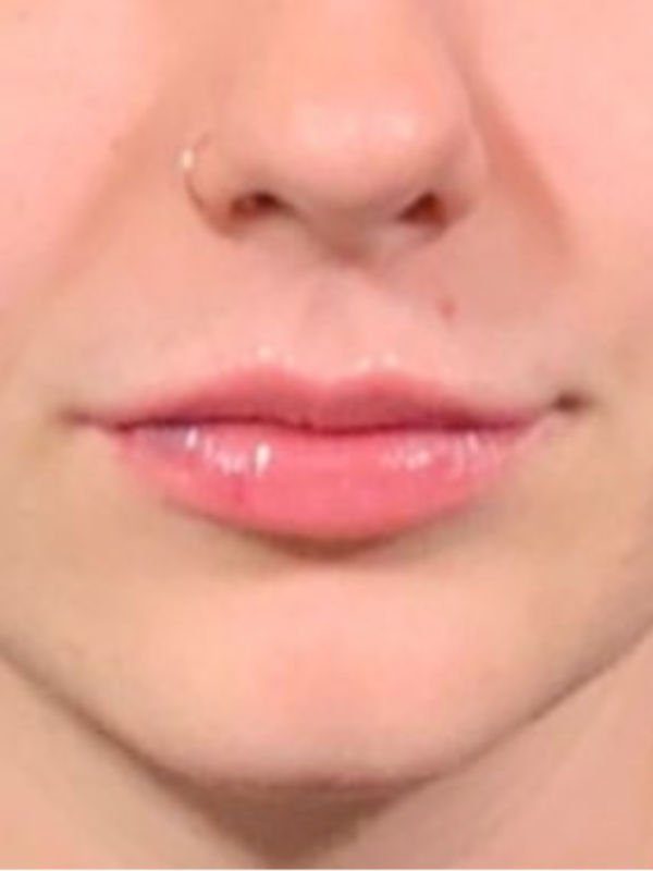 Treatments for Dehydrated Lips