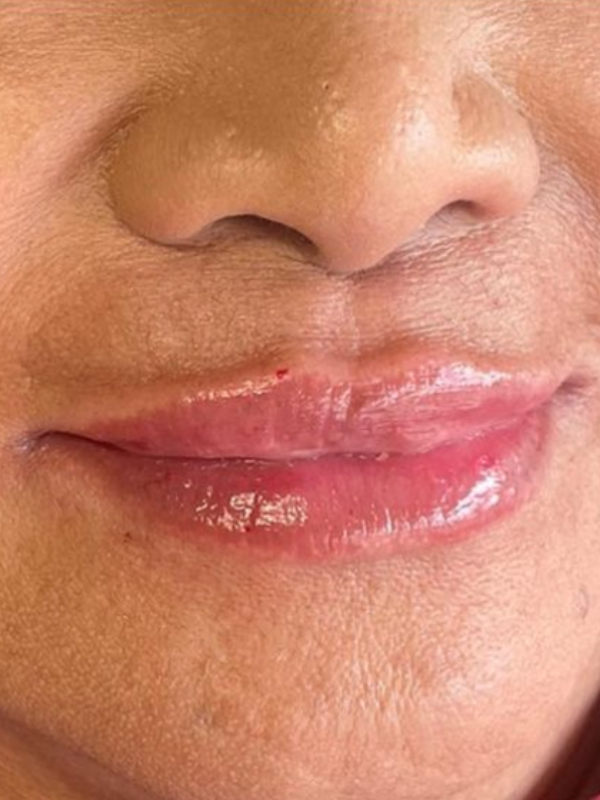 Treatments for Aging Lips