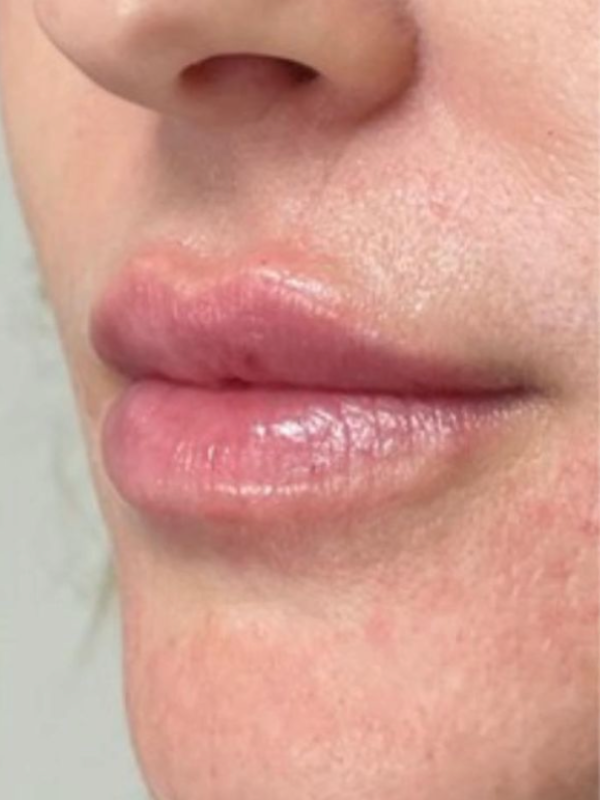 Treatments for Aging Lips