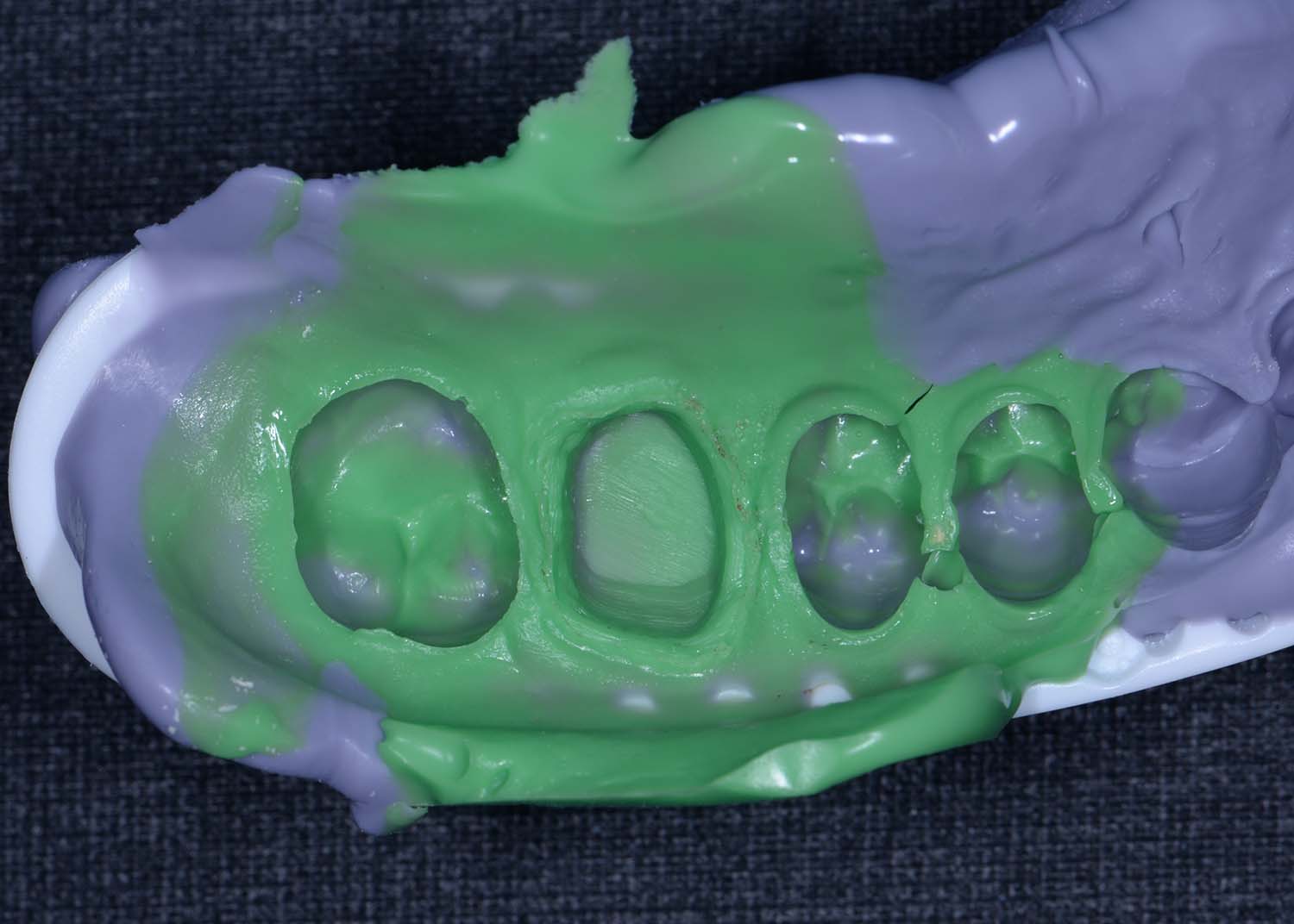 How Long Do Dental Crowns Last?