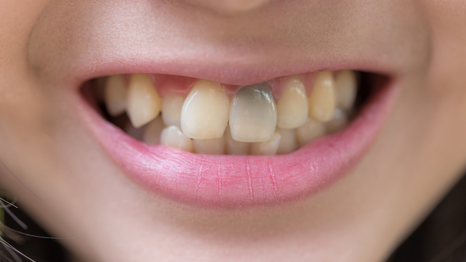 Change teeth. Change teeth. девочка с молочным зубами. Change teeth. Change teeth.