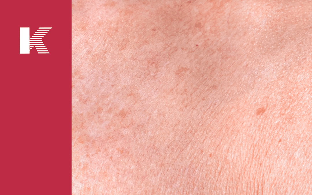 Will Red Light Therapy Help Melasma? Kaiyan Medical