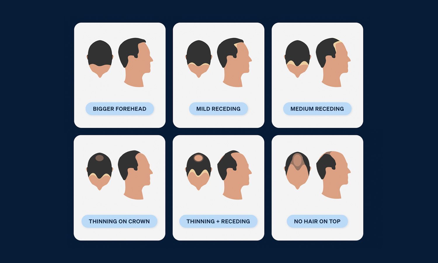 Here s How To Tell If Your Hairline Is Receding Pilot Here s How To Tell If Your Hairline Is Receding Pilot