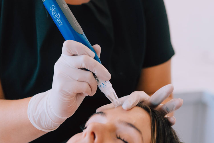 REJUV AVE | Micro-needling